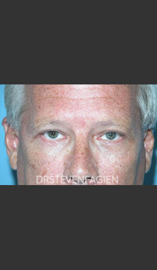 After Photo for Periorbital Rejevenation - Patient 5 - Steven Fagien, MD - Prejuvenation