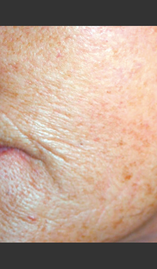 Before Photo for Quanta Eterna IPL Treatment #77 -  - Prejuvenation