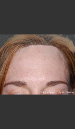 After Photo for Treatment of Forehead Creases - Ron M. Shelton, M.D. - Prejuvenation