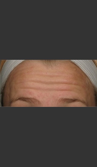 Before Photo for Treatment of Forehead Wrinkles with Botox - Roy G. Geronemus, M.D. - Prejuvenation