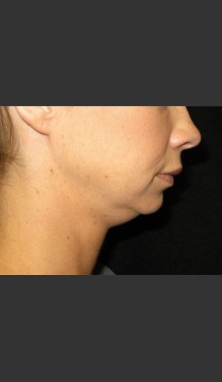 Before Photo for Laser Asissted Liposuction - Robert Aycock - Prejuvenation