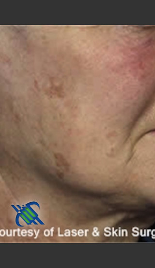 Before Photo for Treatment of Cheek Pigmentation - Roy G. Geronemus, M.D. - Prejuvenation