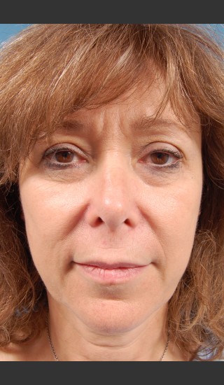 Before Photo for Facelift Surgery - Thomas A. Mustoe, MD, FACS - Prejuvenation