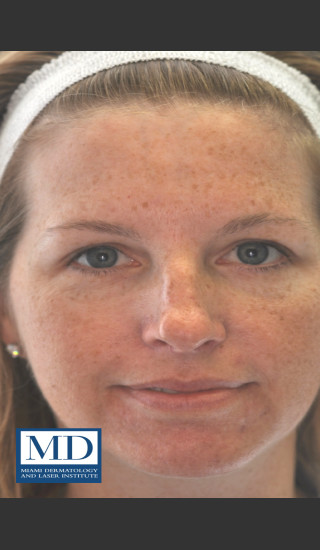 Before Photo for IPL Brown Spots Treatment 109 - Jill S. Waibel, MD - Prejuvenation