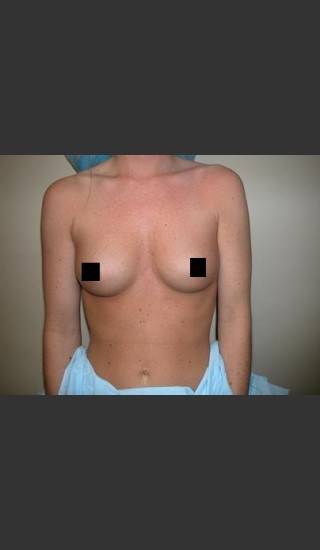 Before Photo for Breast Augmentation - Brian P. Tierney, MD - Prejuvenation