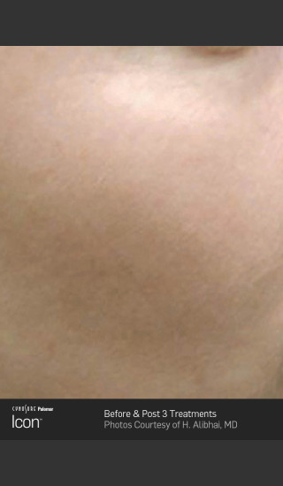 After Photo for Skin Revitalization Before & After Photo -  - Prejuvenation