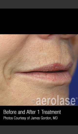 After Photo for Treatment of Smoke Wrinkles #340 -  - Prejuvenation