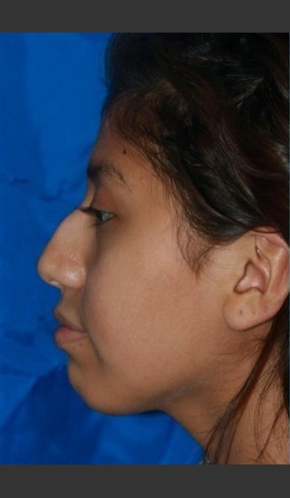 Before Photo for Rhinoplasty - Case 13 - Konstantin Vasyukevich, MD - Prejuvenation
