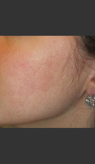 After Photo for Infini Acne Scar Treatment #11 -  - Prejuvenation