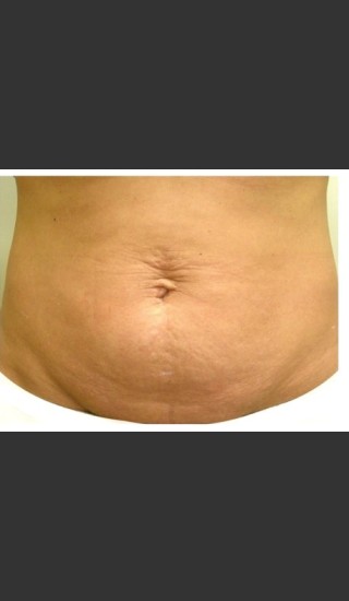 Before Photo for 3DEEP Belly Tightening -  - Prejuvenation