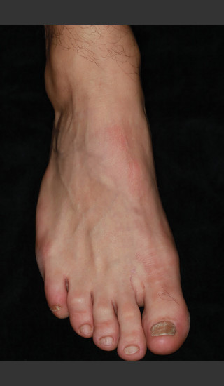 After Photo for Quanta Q-Plus C Laser Tattoo Removal #72 -  - Prejuvenation