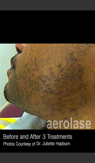 Before Photo for Hair Removal #314 -  - Prejuvenation