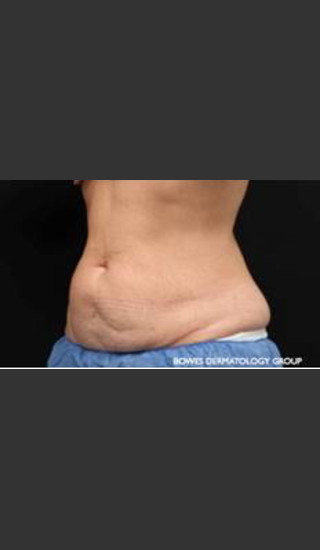 Before Photo for CoolSculpting Treatment of Woman's Abdomen - Leyda Elizabeth Bowes, M.D. - Prejuvenation