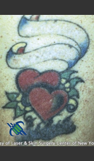 After Photo for Treatment of Arm Tattoo - Roy G. Geronemus, M.D. - Prejuvenation