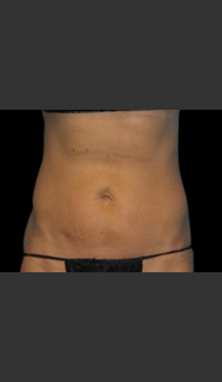 After Photo for Body Contouring Treatment #123 -  - Prejuvenation