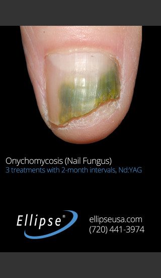 Before Photo for Treatment of Toe Nail Fungus -  - Prejuvenation
