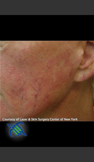 Before Photo for Treatment of Facial Blood Vessels - Roy G. Geronemus, M.D. - Prejuvenation