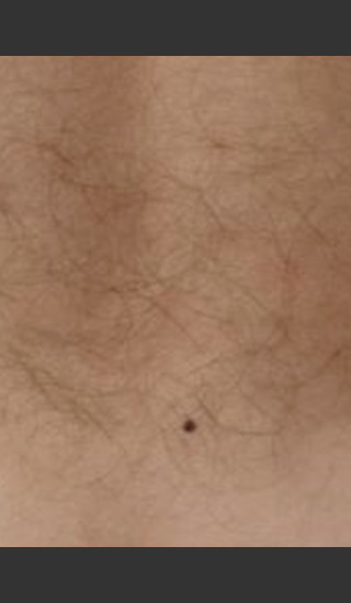 Before Photo for Quanta Eterna IPL Hair Removal #75 -  - Prejuvenation