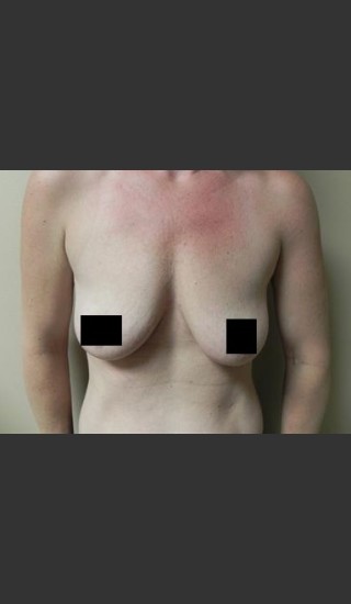 Before Photo for Breast Augmentation - Brian P. Tierney, MD - Prejuvenation