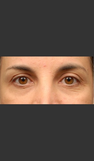 Before Photo for 3DEEP Eye Wrinkle Reduction -  - Prejuvenation
