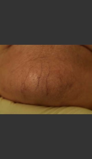 Before Photo for Cutera Laser Treatment - Skin Cancer Specialists P.C. & Aesthetic Center - Prejuvenation