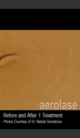 After Photo for Treatment of Striae #345 -  - Prejuvenation