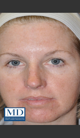 After Photo for IPL Brown Spots Treatment 109 - Jill S. Waibel, MD - Prejuvenation