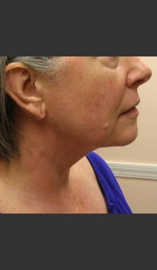 After Photo for Dr. Langdon Precision TX  - Robert Langdon - Prejuvenation