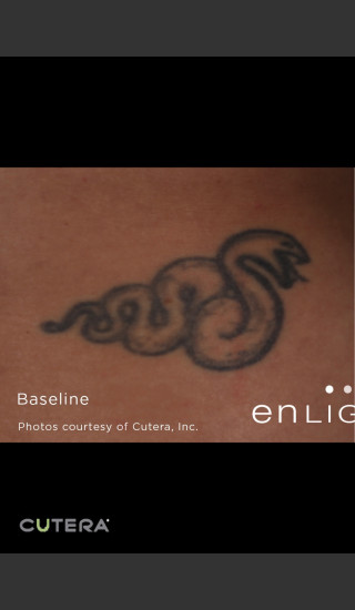 Before Photo for Tattoo Removal of Snake -  - Prejuvenation