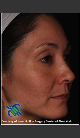After Photo for Treatment of Melasma on the Right Side - Roy G. Geronemus, M.D. - Prejuvenation