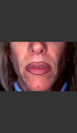 Before Photo for Treatment of Permanent Lip Liner - Roy G. Geronemus, M.D. - Prejuvenation
