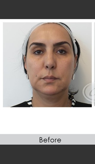 Before Photo for Liquid Face Lift - Annie Chiu, MD - Prejuvenation
