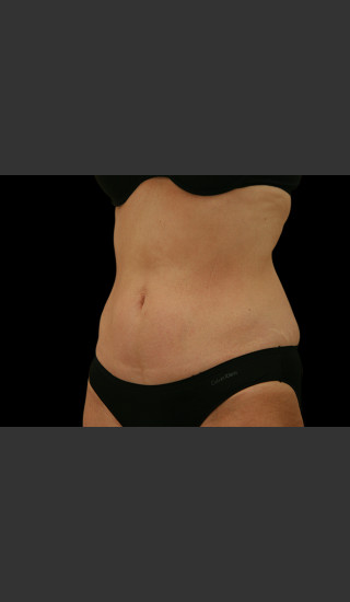 After Photo for Body Contouring Treatment #111 -  - Prejuvenation