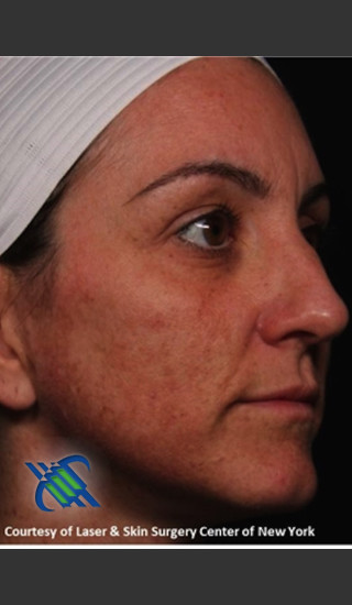 Before Photo for Right Side Full Face Rejuvenation - Roy G. Geronemus, M.D. - Prejuvenation