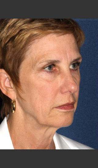 After Photo for Treatment of Sun Damage - Mitchel P. Goldman M.D. - Prejuvenation