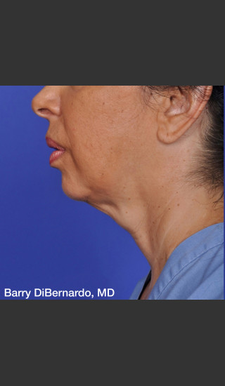 Before Photo for ThermiTight Treatment - Barry E. DiBernardo, MD, FACS - Prejuvenation