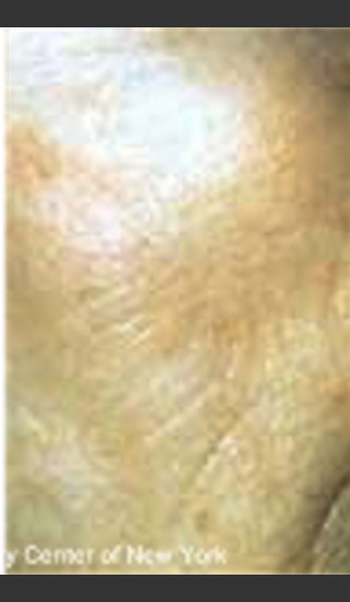 After Photo for Treatment of Facial Pigmentation -  - Prejuvenation