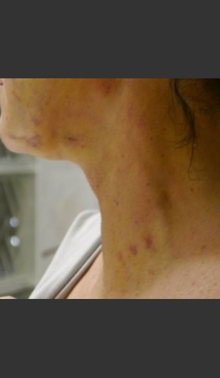 After Photo for Treatment of Neck Brusing - Roy G. Geronemus, M.D. - Prejuvenation