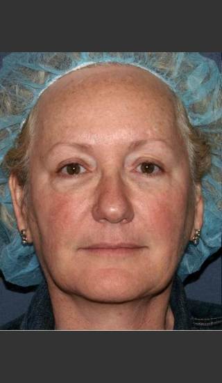 Before Photo for Treatment of Sun Damage & Flushing - Kimberly J. Butterwick M.D. - Prejuvenation