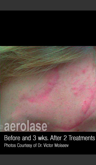 After Photo for Treatment of Traumatic Scars #344 -  - Prejuvenation