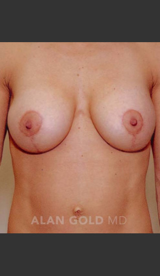 After Photo for Mastopexy and Augmentation 515 - Alan Gold MD - Prejuvenation