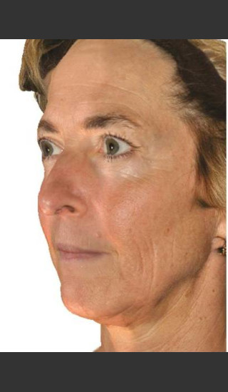 Before Photo for Infini Facial Laxity and Rhytides Treatment -  - Prejuvenation