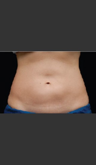 After Photo for Dr. Langdon CoolSculpting - Robert Langdon - Prejuvenation