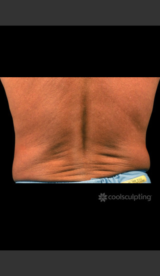 Before Photo for CoolSculpting on Man Flanks (Love Handles) - W. Grant Stevens, MD, FACS - Prejuvenation
