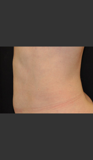After Photo for Body Contouring Treatment #122 -  - Prejuvenation