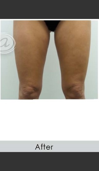 After Photo for Vanquish for Thighs - Annie Chiu, MD - Prejuvenation