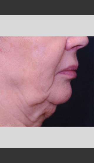 Before Photo for Profound Lift Treatment of Jawline -  - Prejuvenation