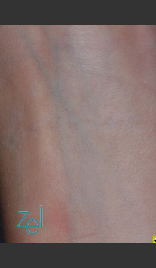 After Photo for Laser Treatment of Forearm Tattoo - Brian D. Zelickson, M.D. - Prejuvenation