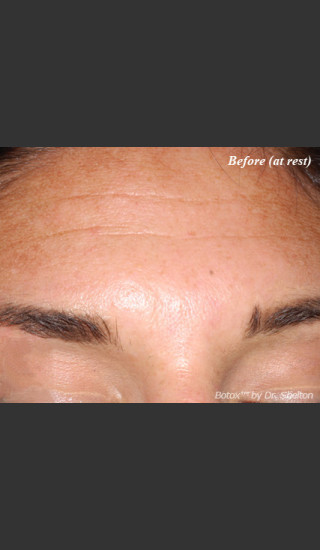 Before Photo for Treatment of Forehead Creases with Botox - Ron M. Shelton, M.D. - Prejuvenation