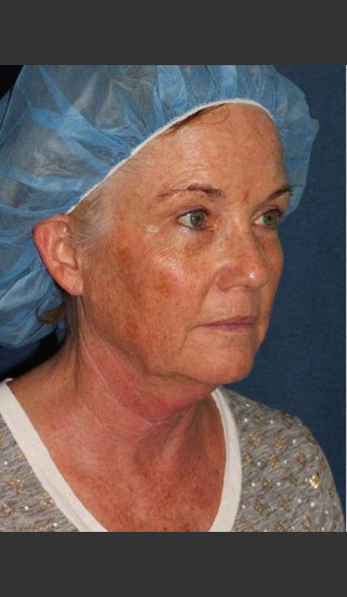 Before Photo for Chin Contouring & Sun Damage Treatment - Kimberly J. Butterwick M.D. - Prejuvenation
